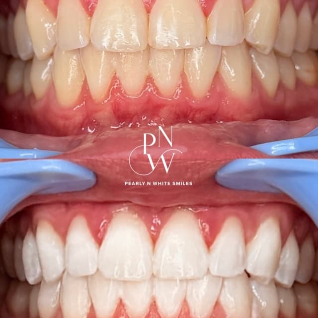 Signature Glow Plan at Pearly N White Smiles in Salem, OR